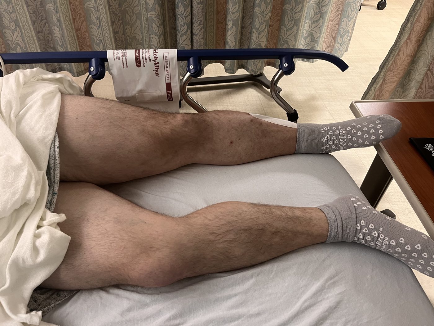 Both of Michael's legs on a hospital bed the morning of his amputation