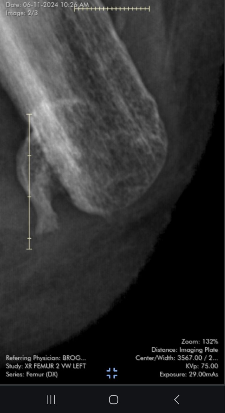 X-ray of the left femur residual limb showing a bone spur