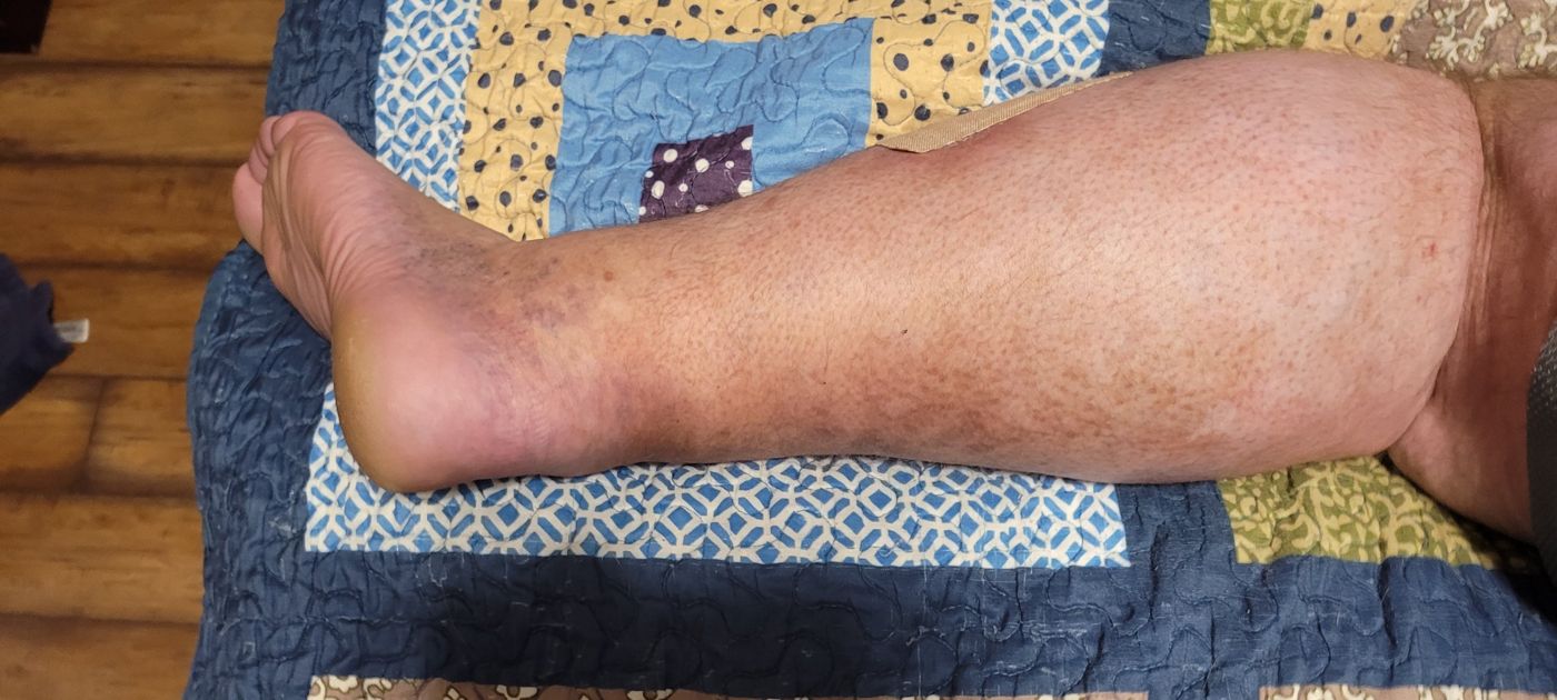 Michael's left lower leg showing post-thrombotic discoloration around the ankle