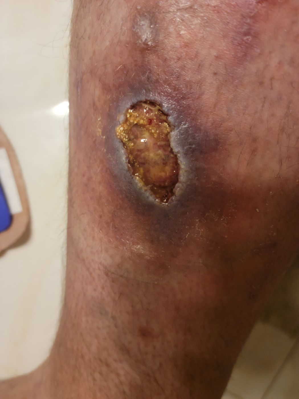 Open venous ulcer on the left calf with slough