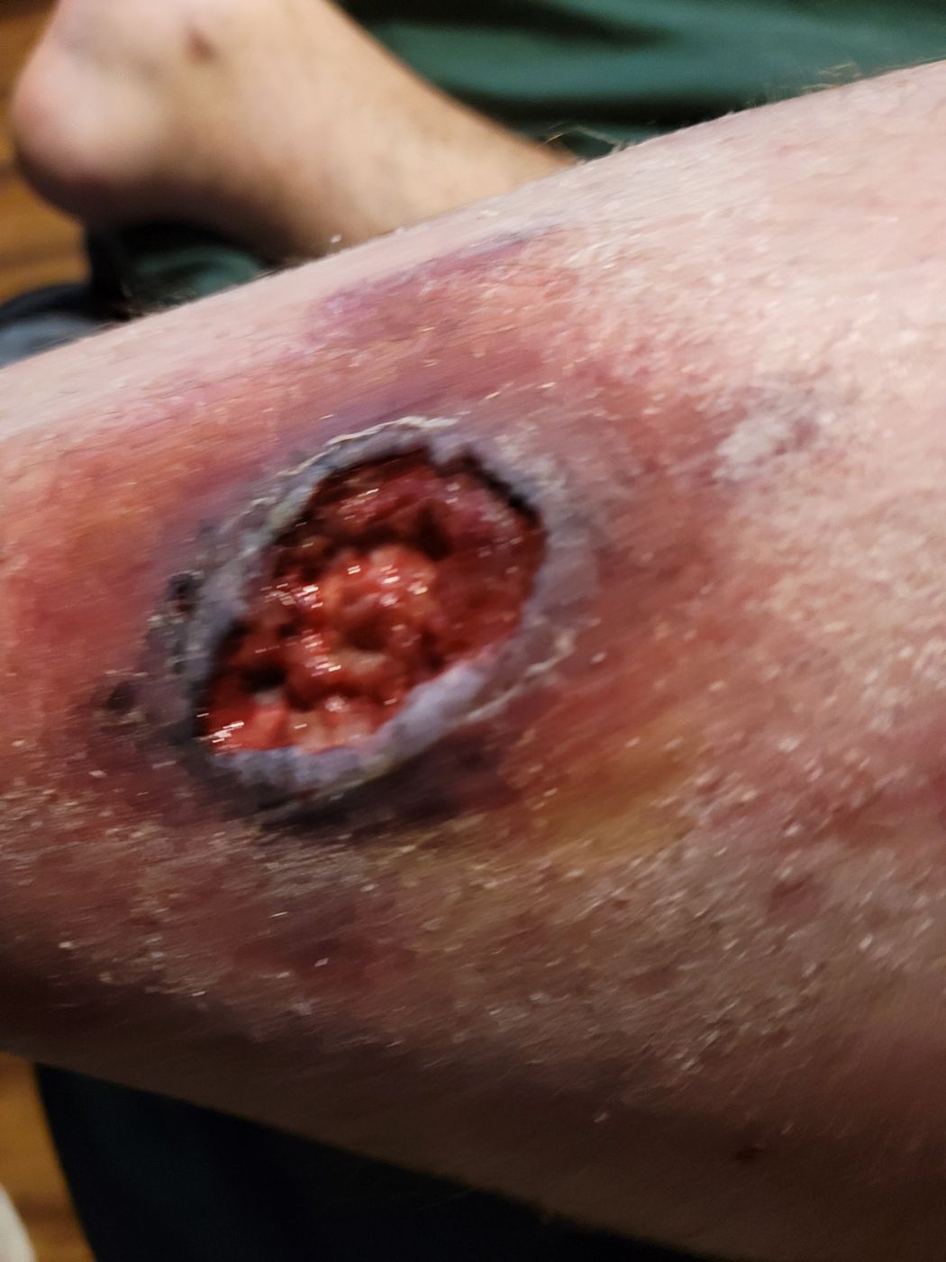 Open venous ulcer on the left calf