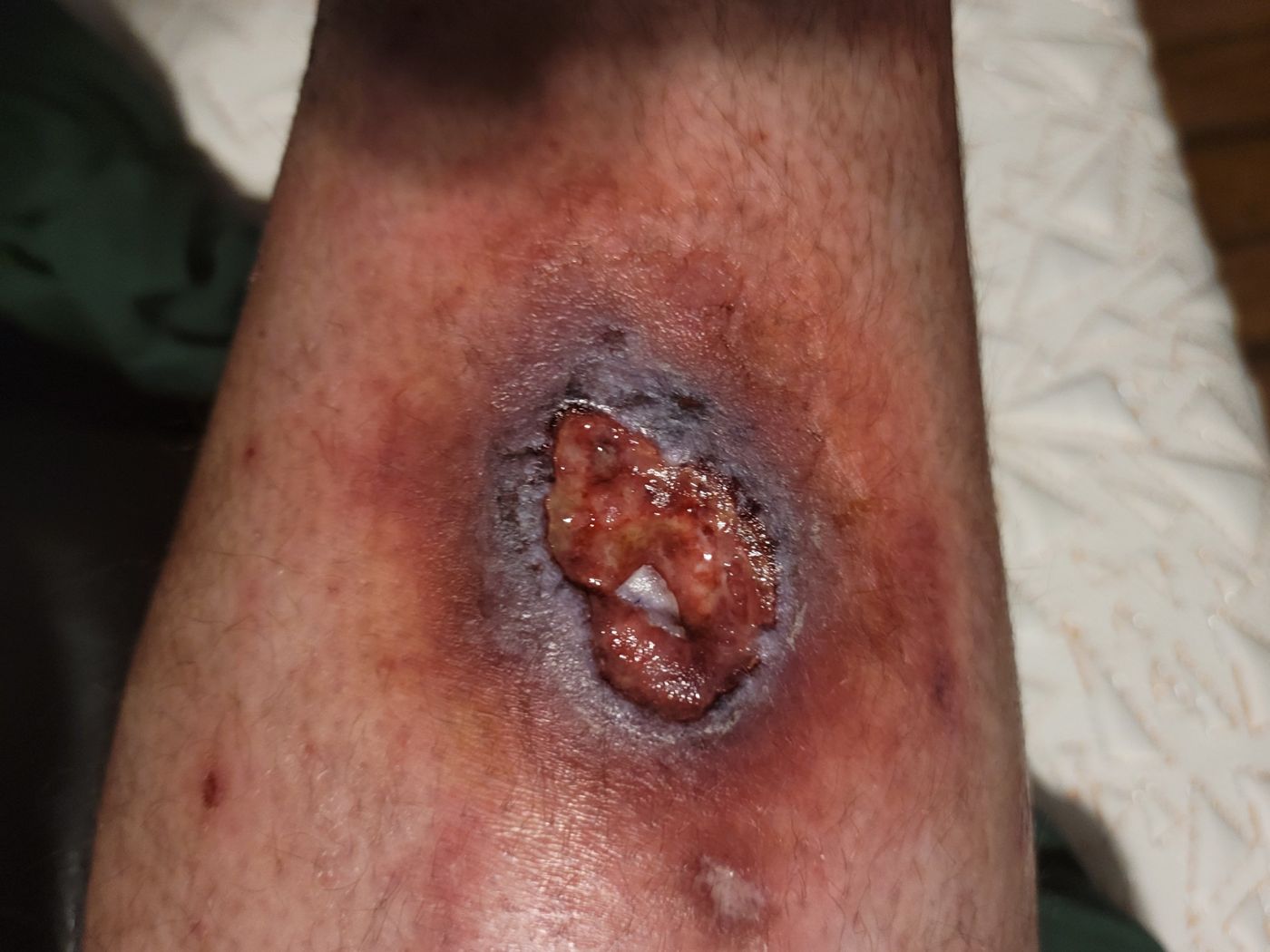 Open venous ulcer with surrounding inflammation