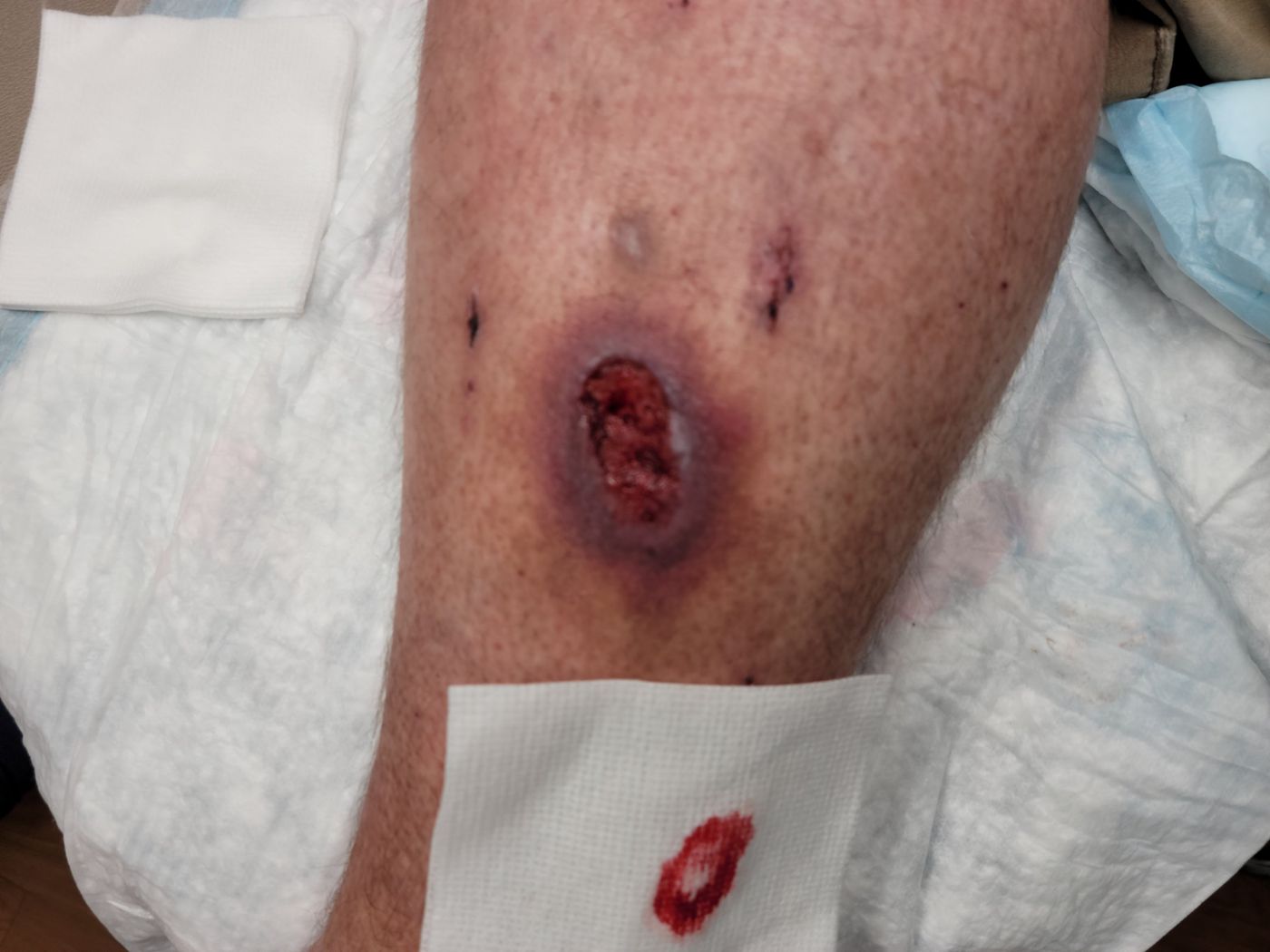 Ulcer after debridement at the wound clinic