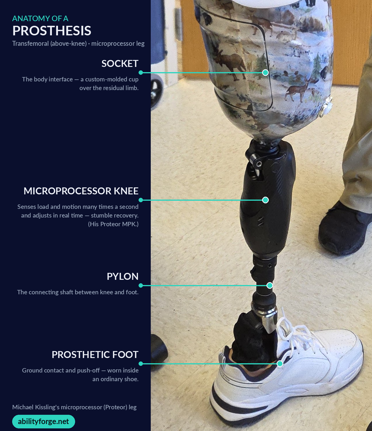 Labeled diagram of a transfemoral microprocessor prosthetic leg — socket, microprocessor knee (MPK), pylon, and prosthetic foot.