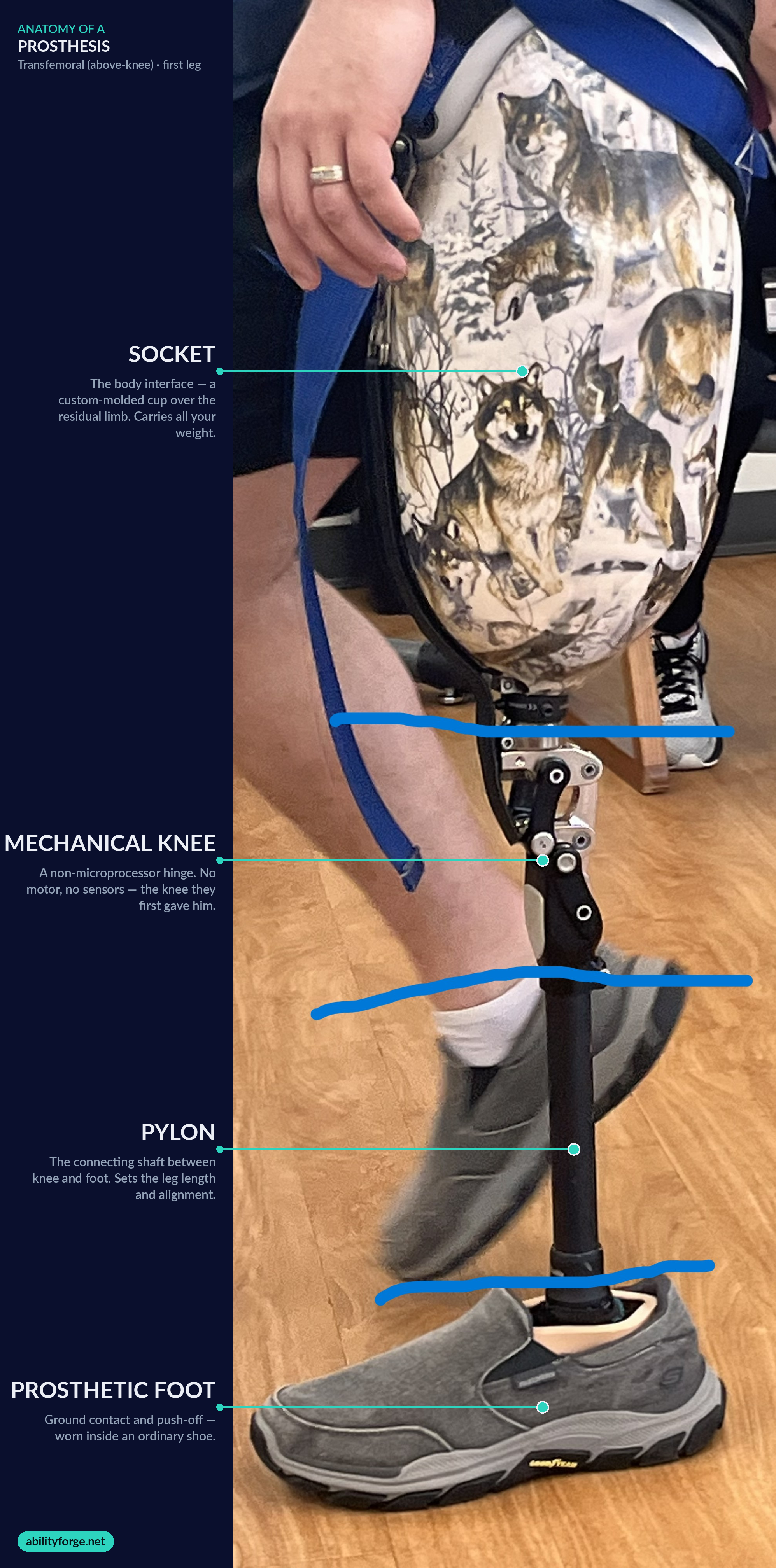 Labeled diagram of a transfemoral prosthetic leg — the mechanical knee is the second component, below the socket and above the pylon.